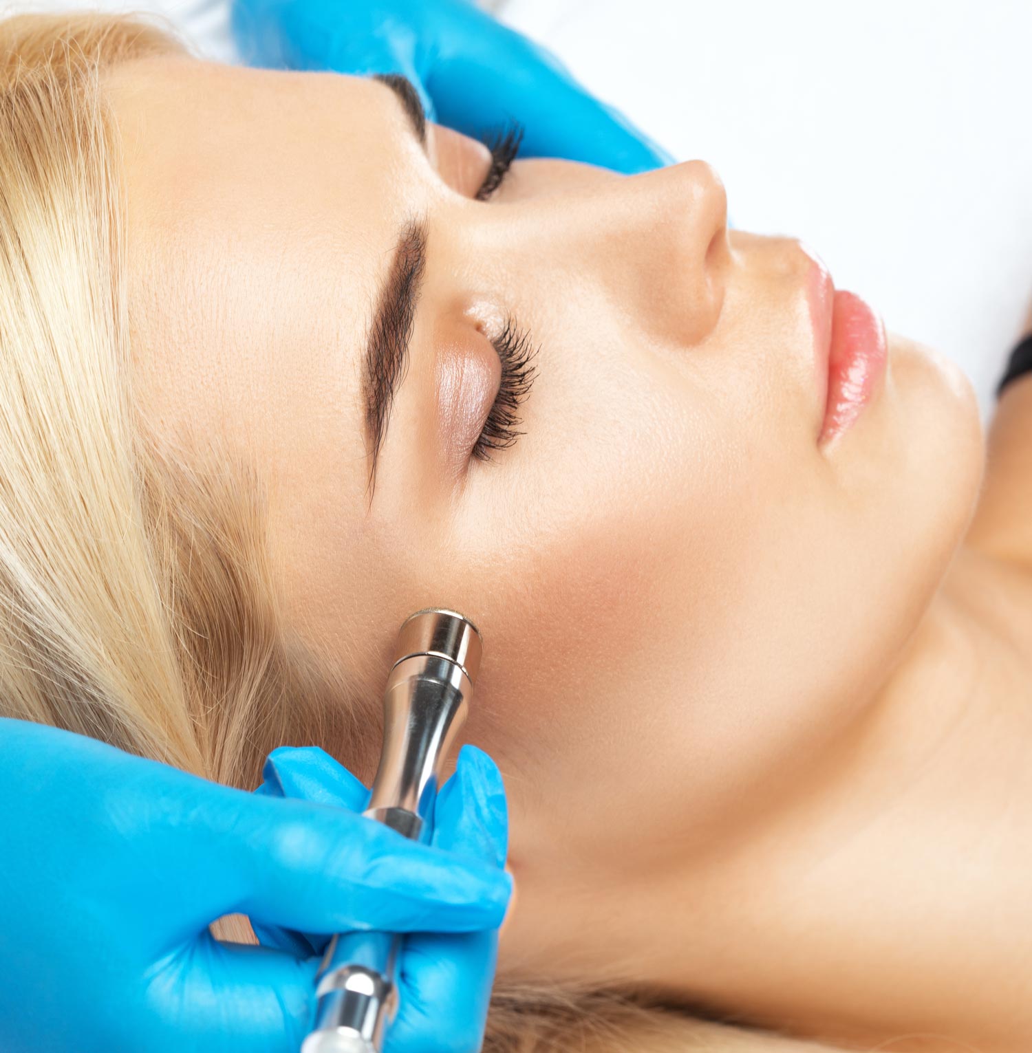 Microdermabrasion